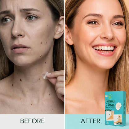 FormuClear™ - Elimina verrugas sin dolor y seguro